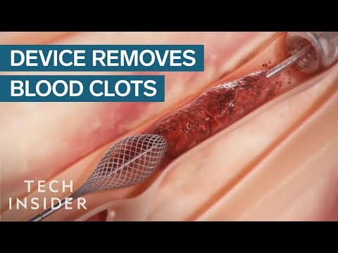 How This Device Safely Removes Blood Clots | Tech Insider