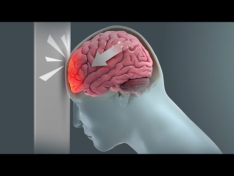 How Traumatic Brain Injury (TBI) Affects Brain Cells - New Research Could Lead to New Treatments